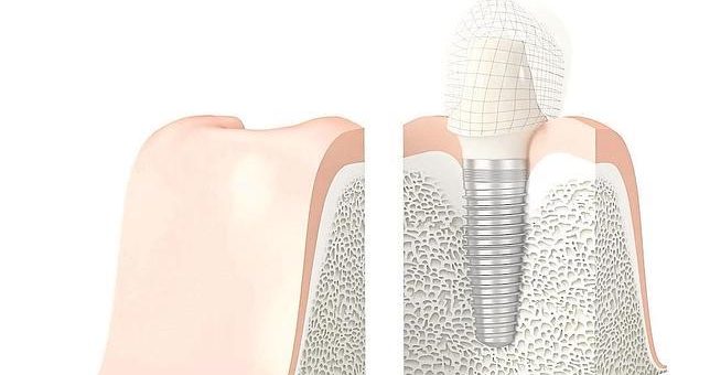 La naturalidad, el último reto de los implantes dentales